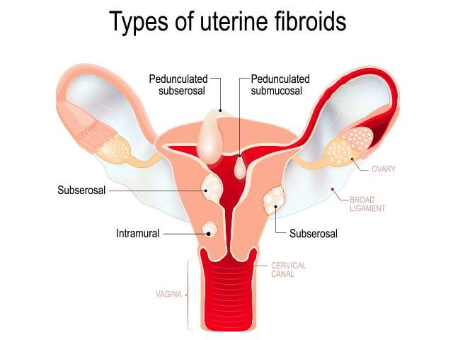 Fibroids