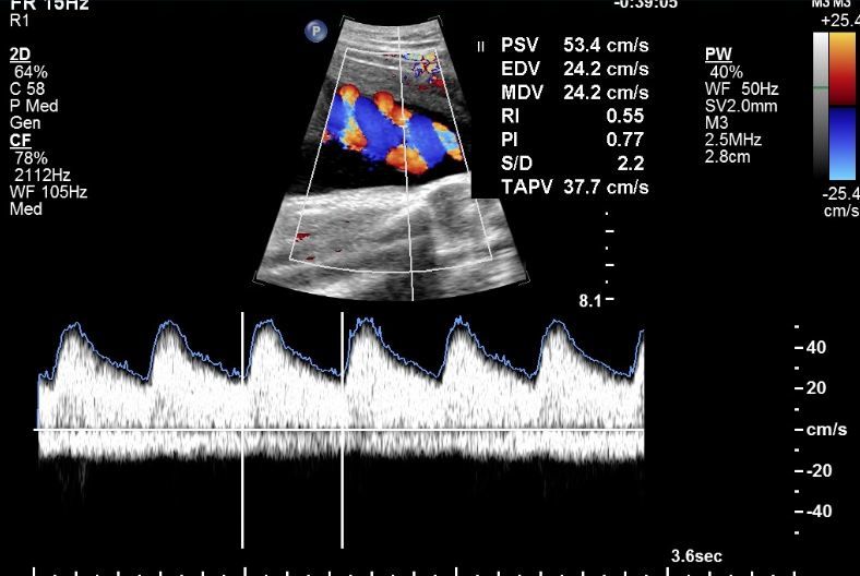 Umbilical Artery Doppler Waveform